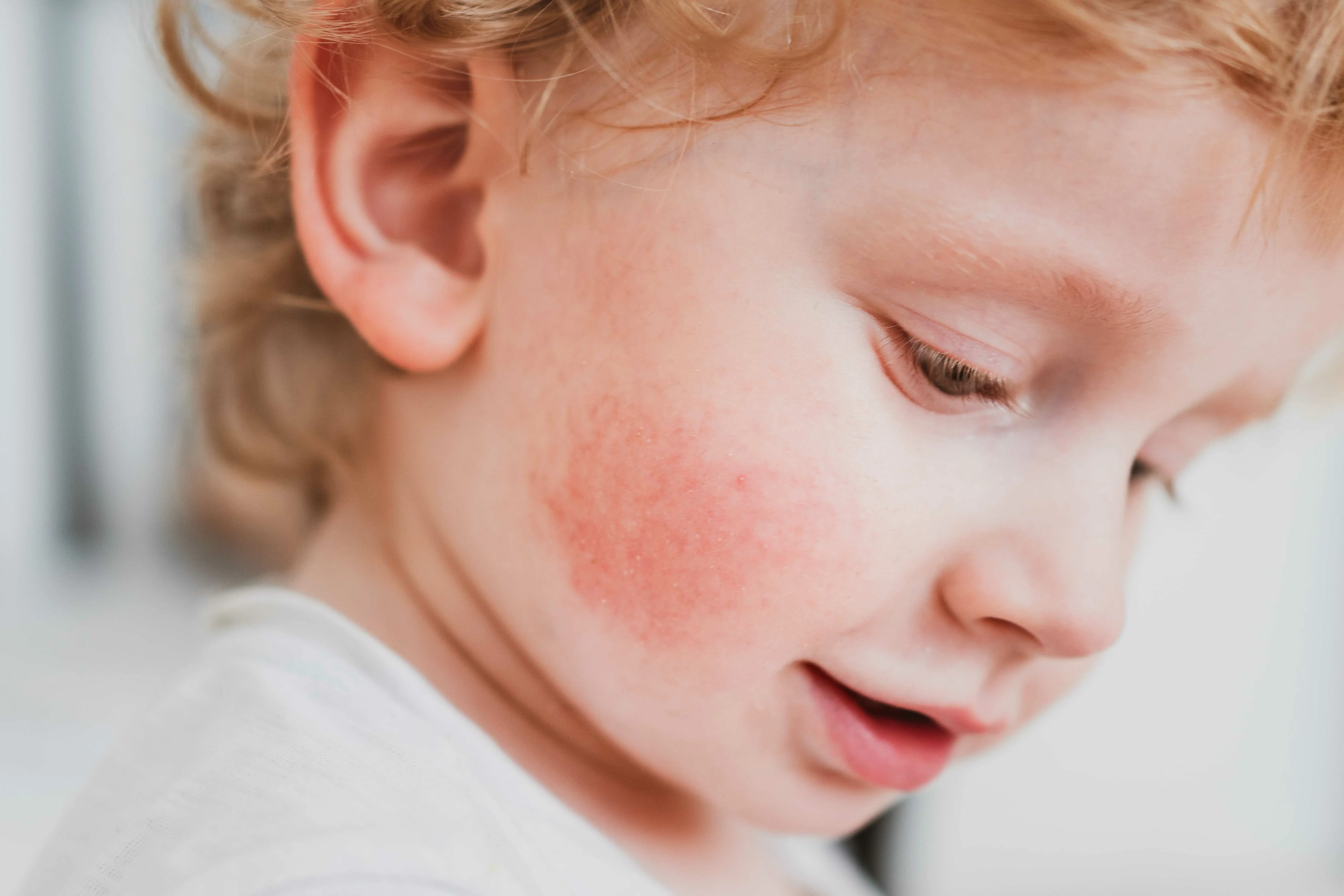Аллергия на коже у детей